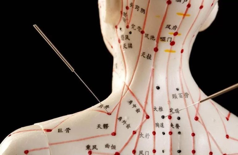 Pain management acupuncture Flushing NY clinic
