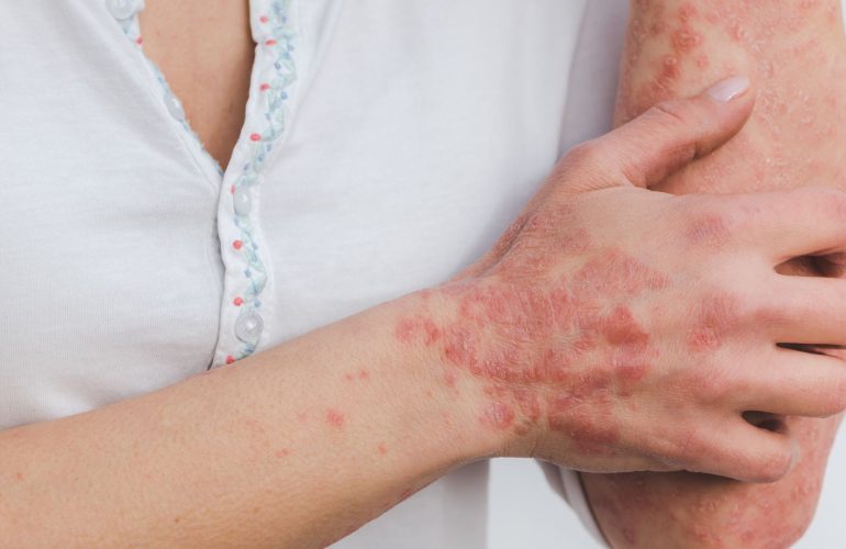 Skin condition acupuncture and herbal medicine Flushing NY